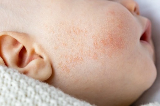 HUMITOPIC kosmetyki do skóry atopowej