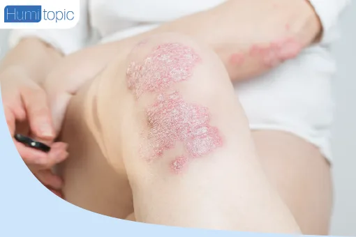 HUMITOPIC kosmetyki do skóry atopowej